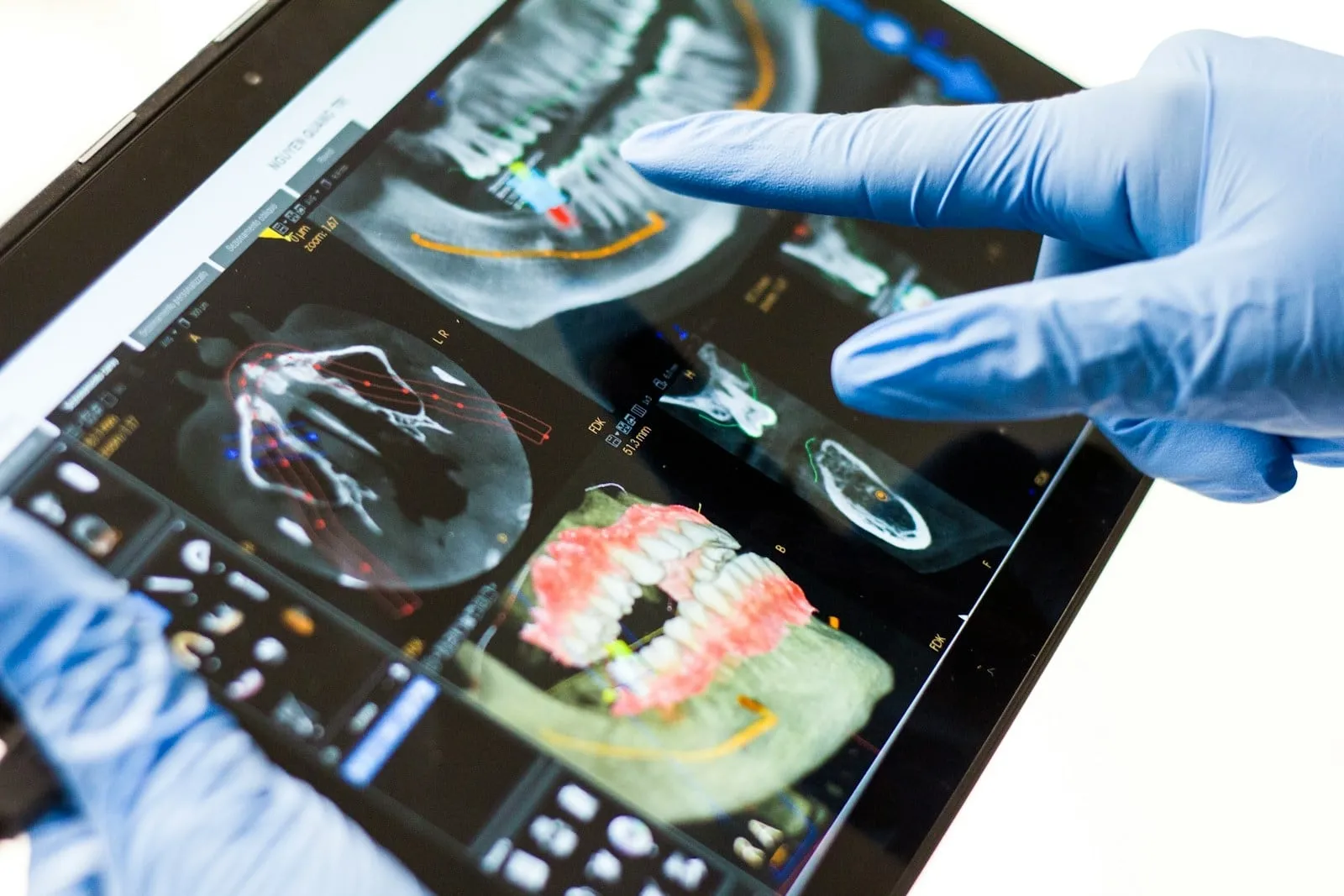 A gloved hand pointing at 3D dental scans on a tablet